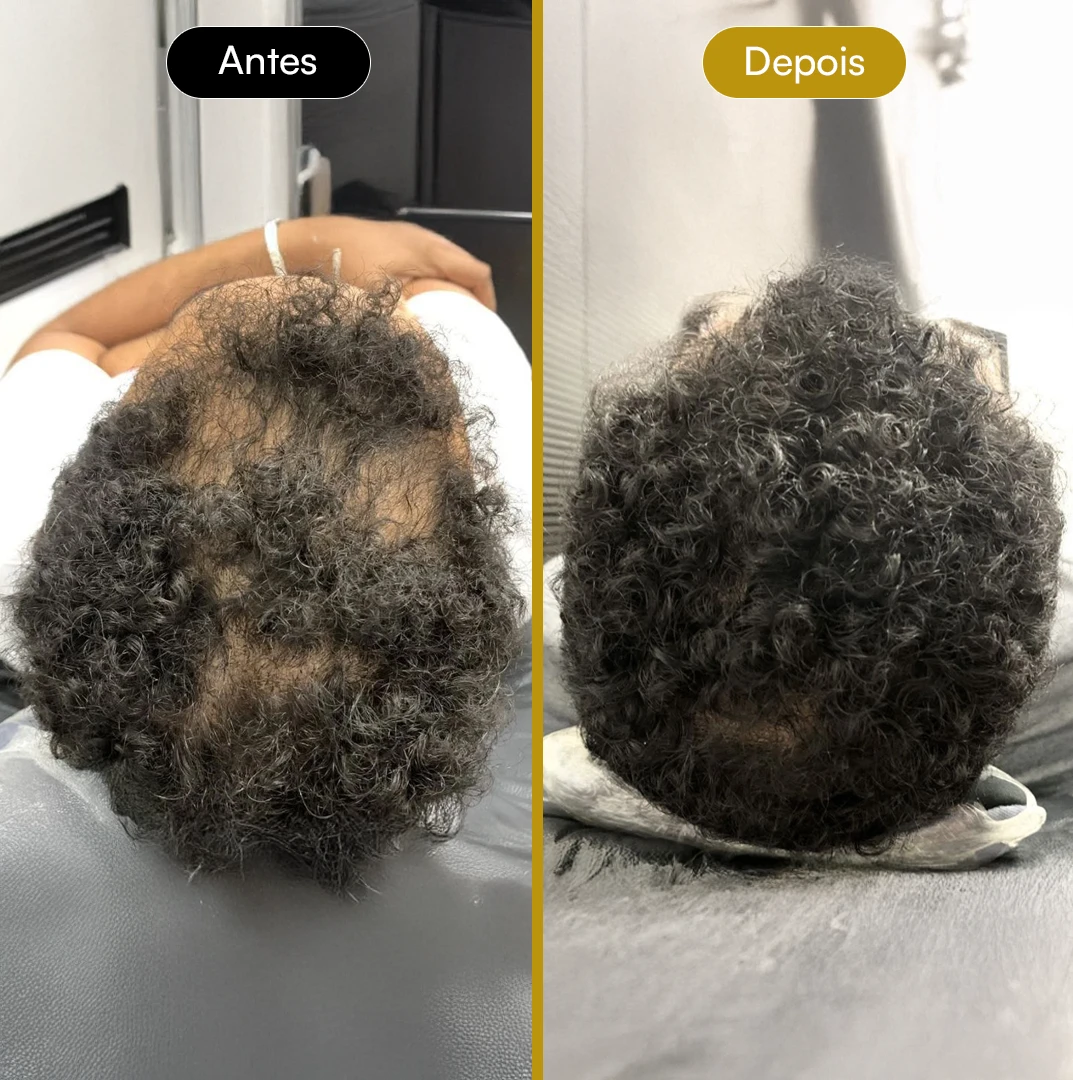 Antes e Depois 03